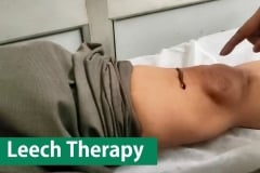Leech-Therapy