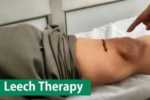 Leech-Therapy